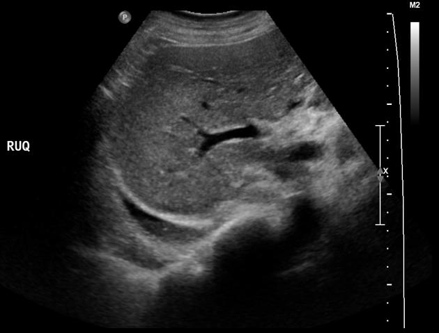 Chest Pleural Effusion Ultrsound